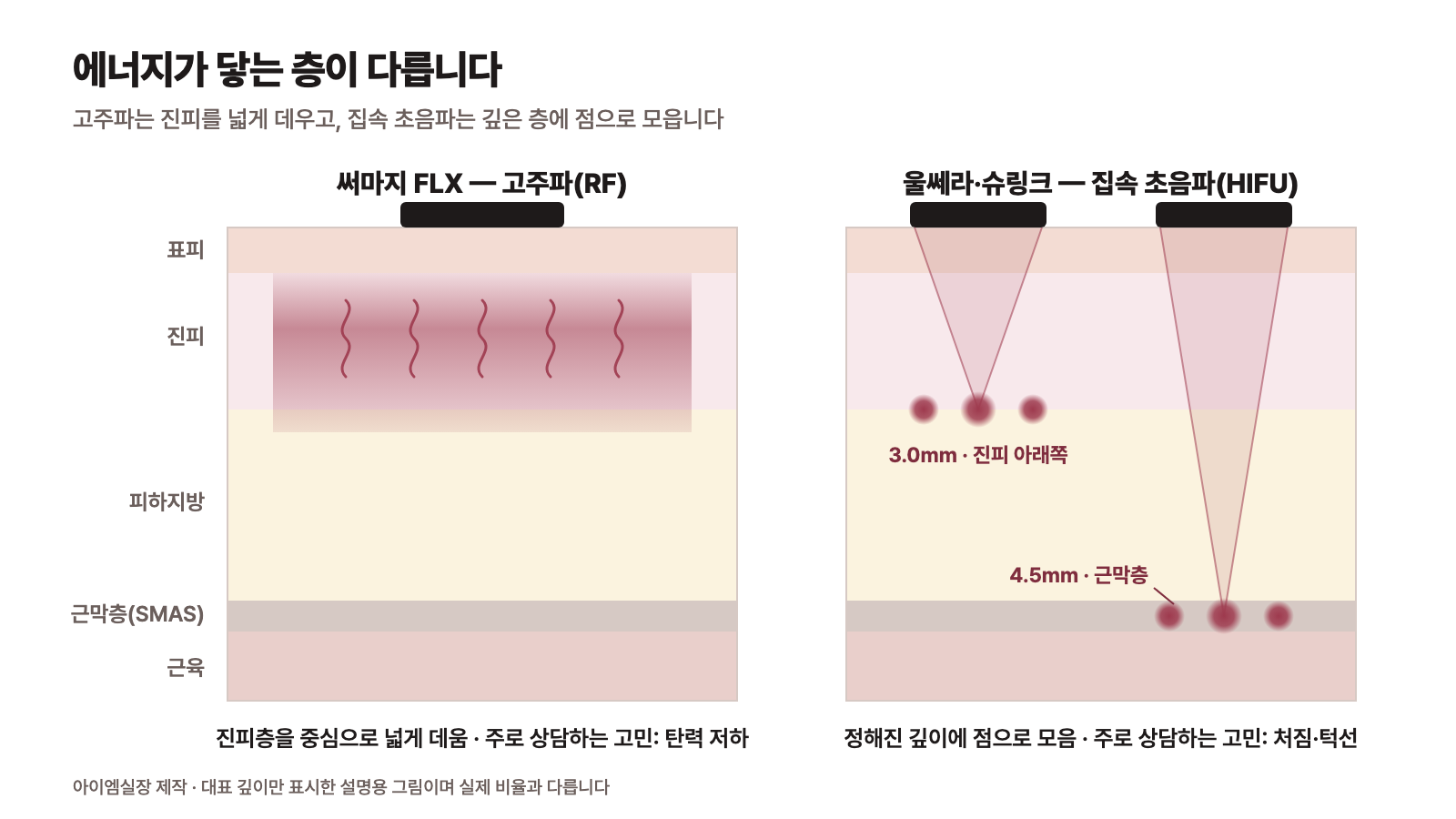 써마지 울쎄라 슈링크 차이: 고주파는 진피층을 넓게, 초음파는 3.0mm·4.5mm 깊이에 점으로 닿는 피부 단면 비교